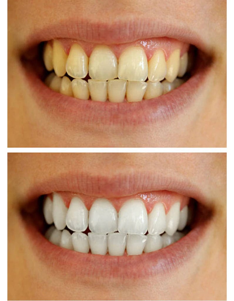 InstaWhite™ Teeth Whitening Pen