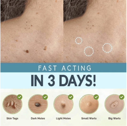 Skin Tag Removal Patches