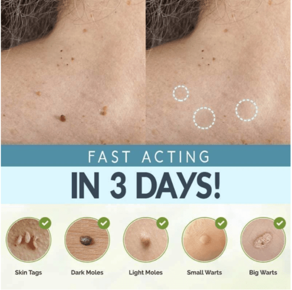 Skin Tag Removal Patches