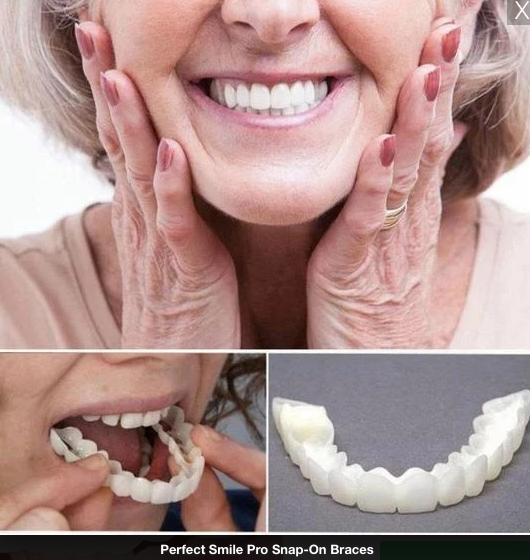 PerfectSmile™ Pro Snap-On Veneers