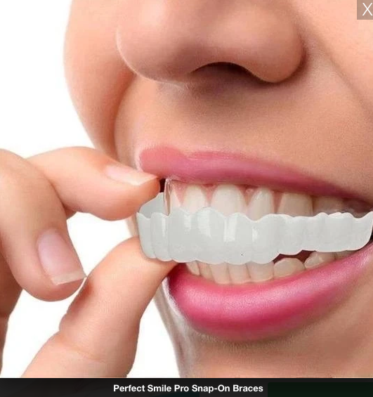 PerfectSmile™ Snap-On Braces